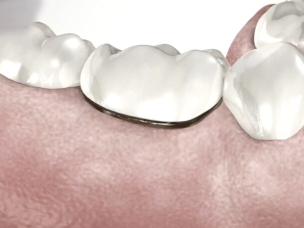 마곡역치과_ &ldquo;얼음물 한 모금에 찌릿?&rdquo;[1. 치수염 원인과 증상] 관련 이미지 3