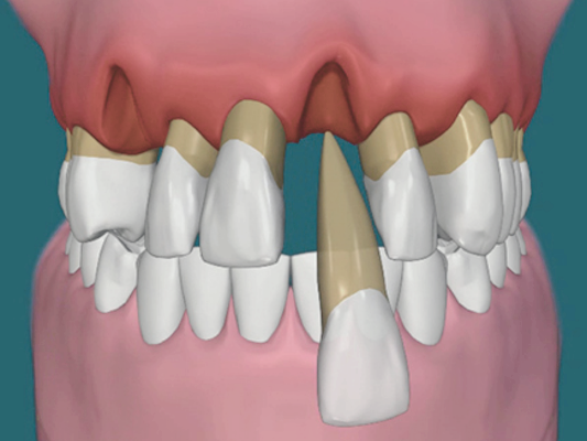 마곡동치과_ "오늘 뽑고 심는 임플란트, 정말 괜찮을까?" [ 2. 당일 임플란트 장점 단점 ] 관련 이미지 5