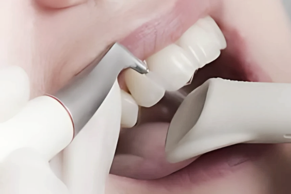 마곡치과_"통증은 줄이고, 상쾌함은 더하다!" [ 1. 에어플로우 스케일링의 원리와 특징 ] 관련 이미지 1