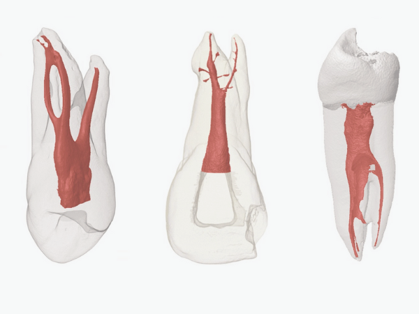 마곡역치과_ 1. 신경치료 후 통증, 왜 생길까? 관련 이미지 4