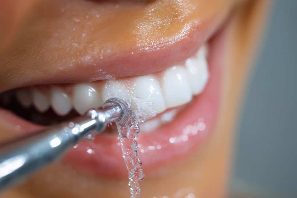 Mokgok Station Dental Clinic_6. Why cavities can come back after treatment, and what to do to prevent recurrence image 2