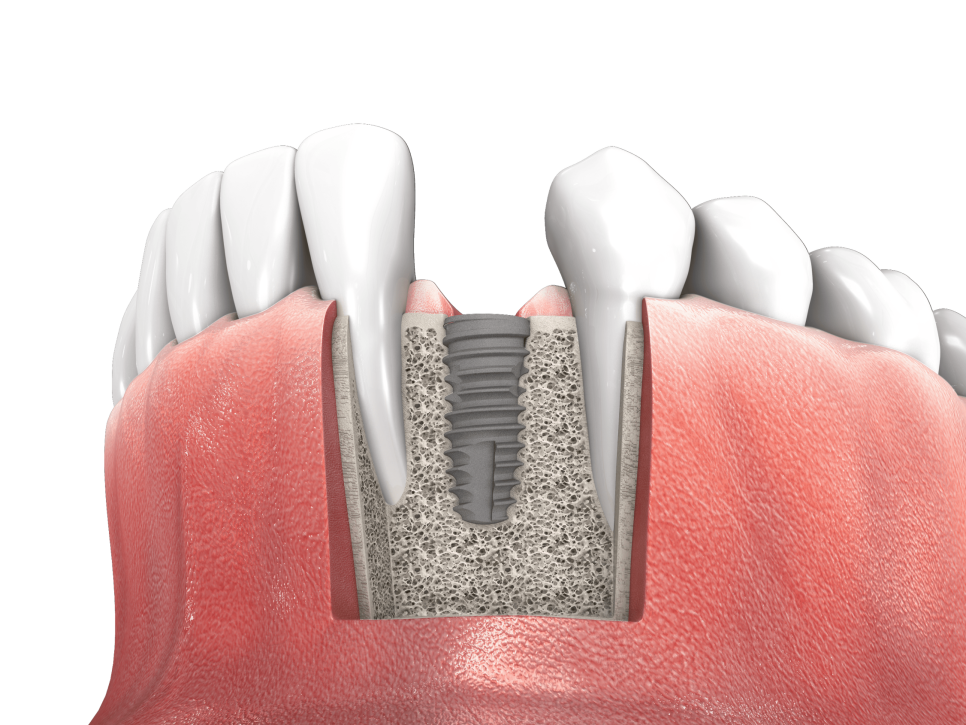마곡역치과_2. 브릿지 치료, 누가 하면 좋을까요? 가능한 경우와 판단 기준 정리 관련 이미지 4