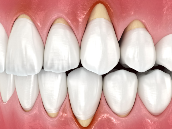 Maggok-dong Dental Clinic_“Signs That Your Gums Are Receding” [2. Step-by-Step Progression of Gingival Recession and Self-Diagnosis Checklist] image 2