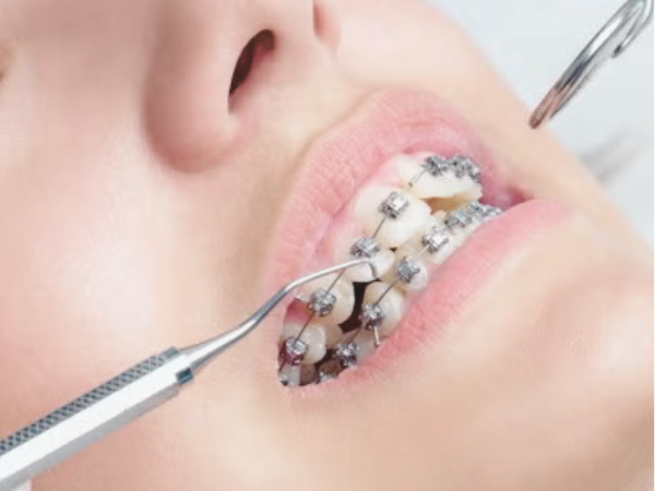 마곡동치과_&ldquo;내려가기 전에! 잇몸을 지키는 진짜 방법 7가지&rdquo;[5. 치은퇴축 예방법] 관련 이미지 2