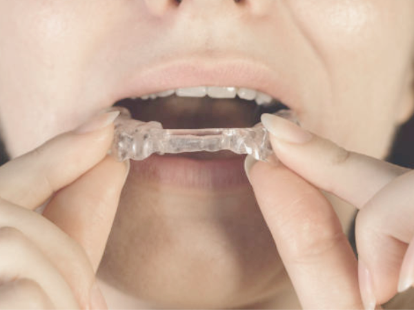 마곡동치과_ "꾸준함이 살린다, 꿀잠 유지의 기술" [ 4. 코골이 장치 관리법 ] 관련 이미지 3