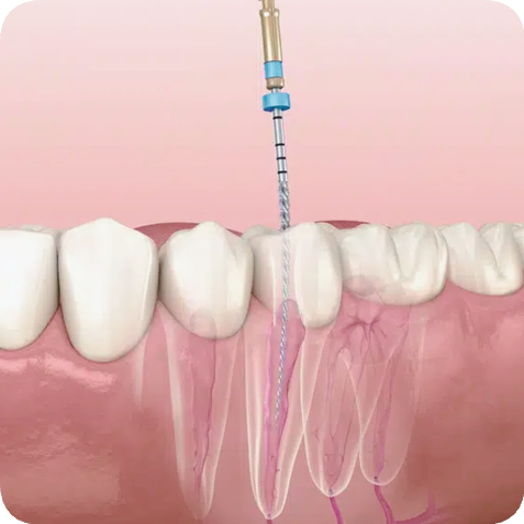 마곡동치과_"방치하면 임플란트까지?" [ 3. 충치 진행 단계별 치료 ] 관련 이미지 7