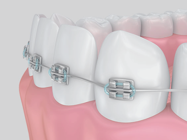 마곡역치과_&ldquo;불소도 다 똑같지 않아요!&rdquo;[2. 불소 종류와 상황별 선택법] 관련 이미지 8