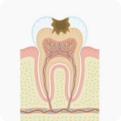 마곡동치과_"방치하면 임플란트까지?" [ 3. 충치 진행 단계별 치료 ] 관련 이미지 4