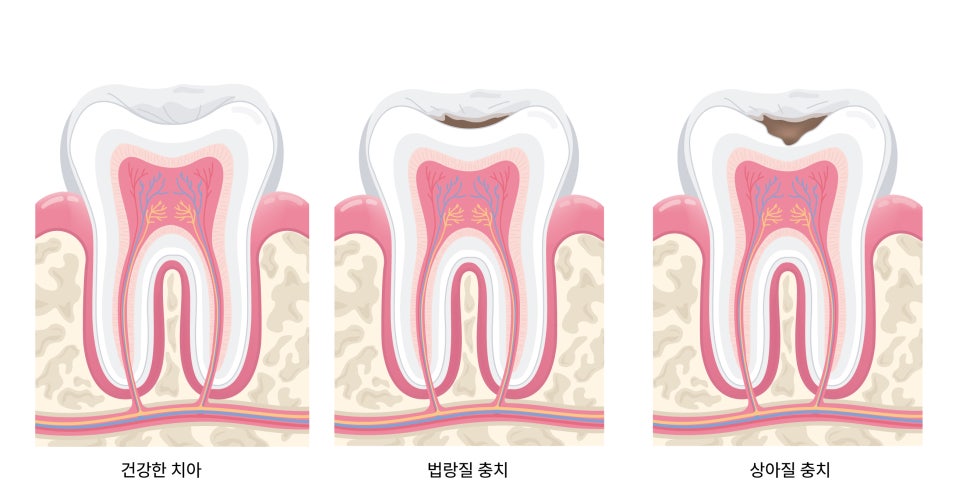 마곡역치과_3. 레진으로 안 된다면? 인레이가 필요한 순간과 선택 기준 관련 이미지 2