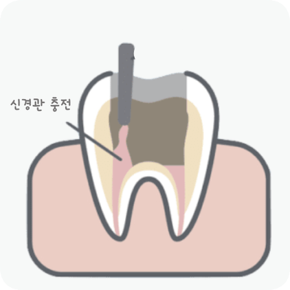 마곡동치과_ "치아 속 구조 복원 프로젝트" [2. 신경치료 단계별 진행 과정 ] 관련 이미지 4