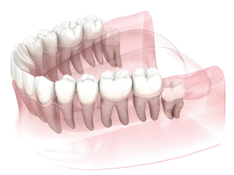 마곡역치과_3. 사랑니에도 종류가 있다? 매복, 수평, 정상 사랑니 비교 관련 이미지 1
