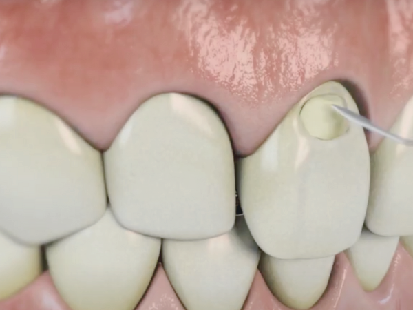 마곡역치과_ &ldquo;참지 말고 잡자!&rdquo; [ 2. 시린이(지각과민증) 치료 ] 관련 이미지 3