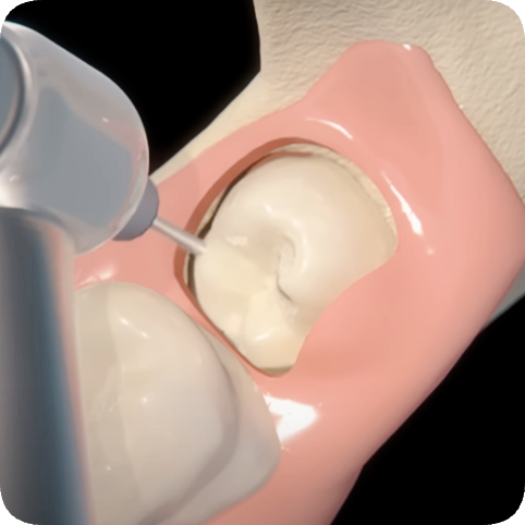 마곡역치과_4. 사랑니 발치, 어떤 과정을 거치나요? 관련 이미지 4