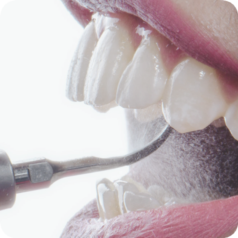 마곡동치과_전문가 미백 관련 이미지 3