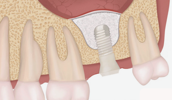 마곡동치과_1. 상악동거상술 꼭 해야 하나요? 안 하면 생기는 문제 관련 이미지 2