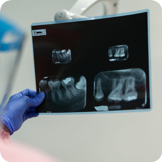 마곡역치과_ 4. 글래스아이오노머(GI) 충치 치료 과정 관련 이미지 1