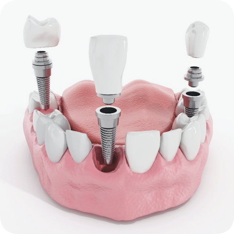 마곡동치과_"방치하면 임플란트까지?" [ 3. 충치 진행 단계별 치료 ] 관련 이미지 9