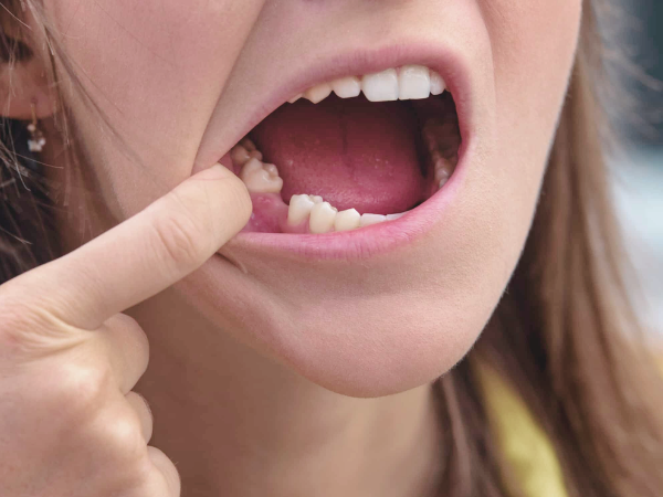 [ 마곡동치과_치아 상실 2 ] 치아 빠졌을 때 치료, 지금 해야 할까요? 미루면 더 복잡해집니다 관련 이미지 1