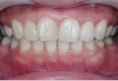 마곡동치과_4. 무삭제 라미네이트(디아네이트) 리얼 후기 3가지 케이스 관련 이미지 5