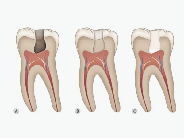 마곡역치과_ &ldquo;참으면 더 커지는 통증?&rdquo; [2. 치수염 치료] 관련 이미지 1