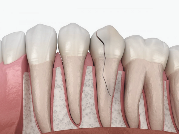 마곡역치과_&ldquo;금의 깊이가 다르면 치료도 달라집니다!&rdquo;[3. 치아 금(균열) 치료] 관련 이미지 9