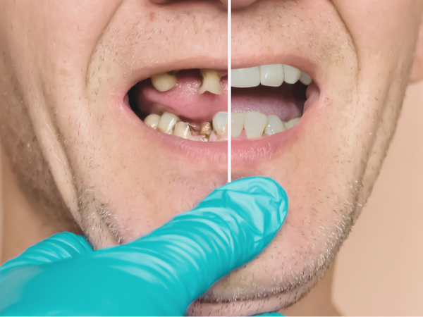 Magok-dong Dental Clinic_3. 6 Must-Check Points Before Full-Mouth Implant Surgery image 3