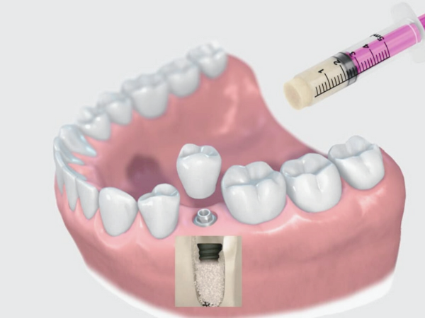 마곡동치과_4. 임플란트 뼈이식 비용과 결정 요인 관련 이미지 1