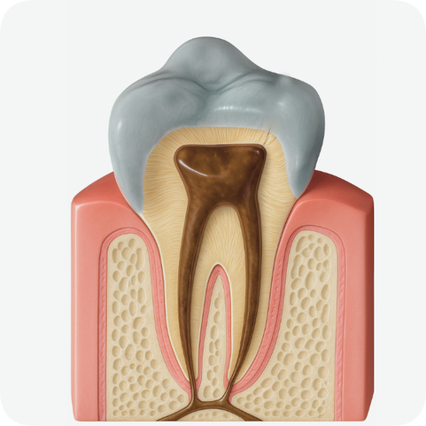 마곡역치과_ 신경이 죽은 치아를 다시 하얗게! [ 2. 실활치 미백&rsquo;의 원리와 과정 ] 관련 이미지 2