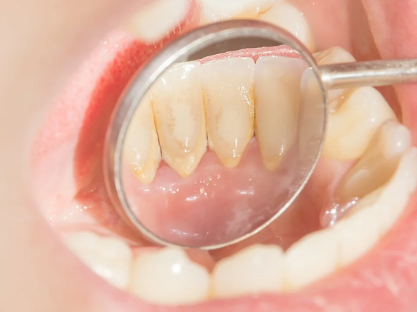 마곡동치과_"붓고 고름이 나와요" [1. 잇몸 고름 주머니 원인] 관련 이미지 2