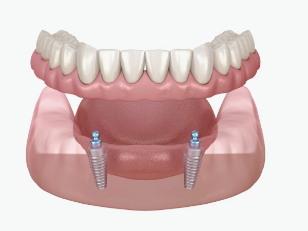 마곡동치과_ &ldquo;씹고 뜯고 맛보는 즐거움!&rdquo; [ 3. 임플란트 틀니의 장점 ] 관련 이미지 5