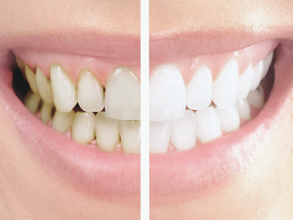 마곡치과_"삭제없이 환하게" [1. 치아 미백치료 원리] 관련 이미지 1