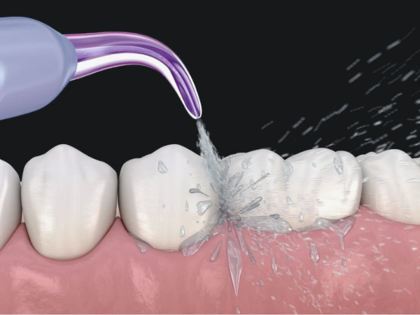 마곡동치과_3. 스케일링 비용, 건강 보험 적용되나요? 1년에 한 번 혜택 총정리 관련 이미지 3