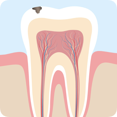 마곡치과_"이럴 땐 레진이 답입니다" [ 1. 치과 레진 활용법 ] 관련 이미지 2