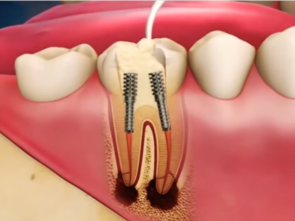 마곡역치과_ 2. 글래스아이오노머(GI) 적응증 관련 이미지 4