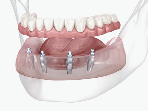 Magok Station Dental Clinic_“What Is Right for Me?” [2. A Complete Guide to Denture Types] image 3