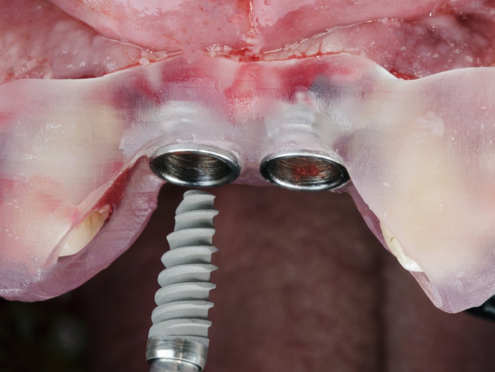 마곡치과_"기존 임플란트와 뭐가 다른가요" [1.3D 네비게이션 임플란트 기본] 관련 이미지 3