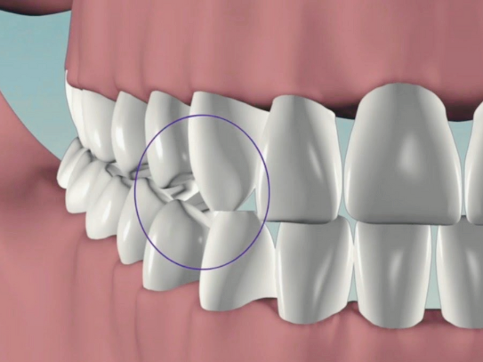 마곡동치과_ &ldquo;왜 내 이는 조금씩 닳아가고 있을까?&rdquo;[1. 치아마모 원인] 관련 이미지 5