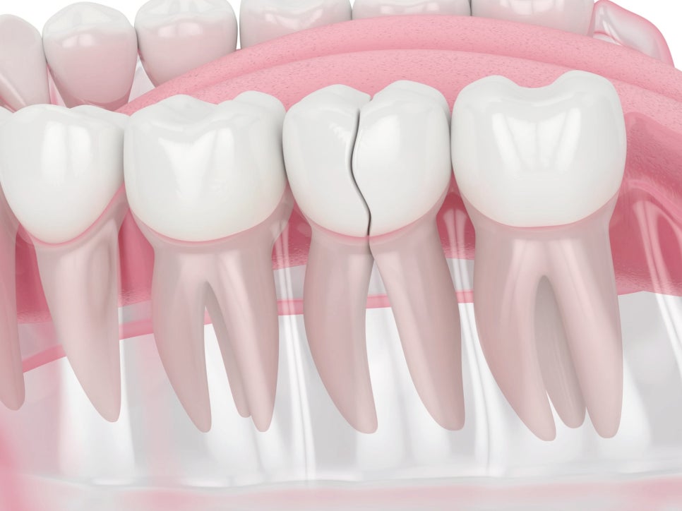 마곡역치과_1. 치수염이란? 치아 속 신경에 염증이 생기는 이유 관련 이미지 4