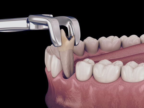 [ 마곡동치과_치아 상실 1 ] 이가 빠지면 생기는 문제, 방치하면 어떻게 될까요? 관련 이미지 1