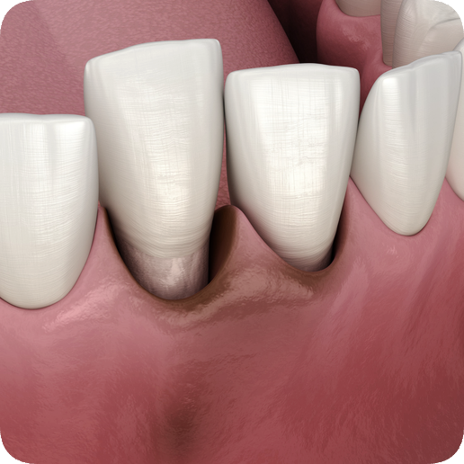 마곡동치과_3. 치주질환 자가진단 체크! 내 잇몸은 안전할까? 관련 이미지 8