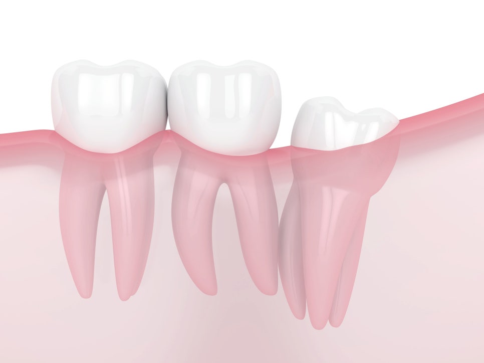 마곡역치과_3. 사랑니에도 종류가 있다? 매복, 수평, 정상 사랑니 비교 관련 이미지 2