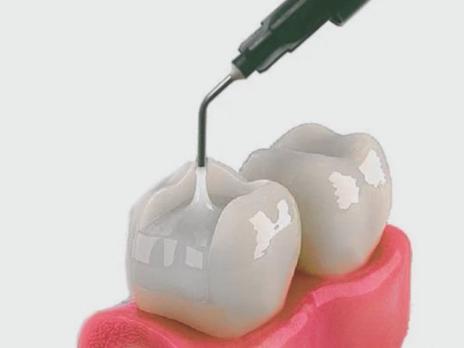 마곡역치과_ 3. 글래스아이오노머(GI) 비용 [feat. 건강보험] 관련 이미지 3