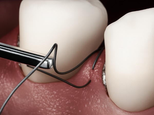 마곡동치과_ &ldquo;안전한 준비, 깔끔한 진행!&rdquo; [ 4. 당일 임플란트 수술 과정 ] 관련 이미지 6