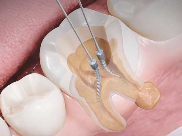 마곡치과_3. 재신경치료 과정, 신경치료 후 다시 아플 때 어떻게 진행될까요? 관련 이미지 2