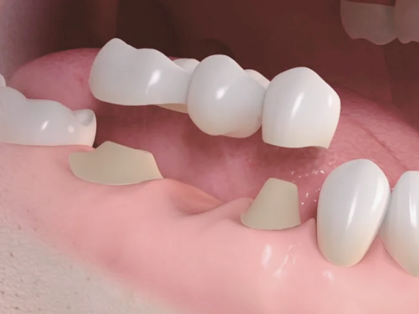 마곡동치과_1. 브릿지 치료란 무엇인가요? 임플란트, 틀니와 차이부터 정리합니다 관련 이미지 2