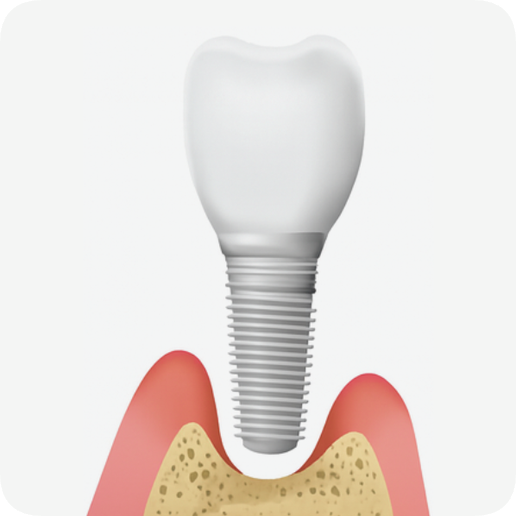 마곡동치과_"조용히 시작해 결국 흔들리는 이유" [ 3. 임플란트 주위염 진행 과정 ] 관련 이미지 4