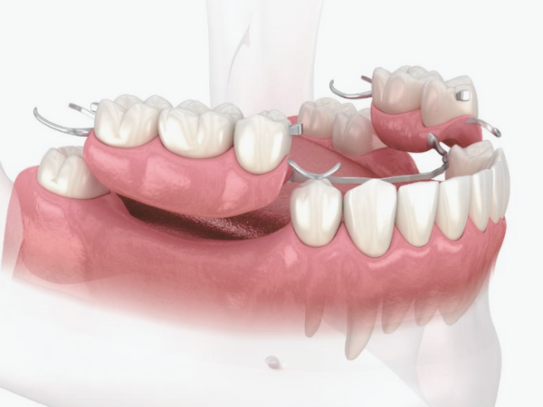 Magok Station Dental Clinic_“What Is Right for Me?” [2. A Complete Guide to Denture Types] image 1