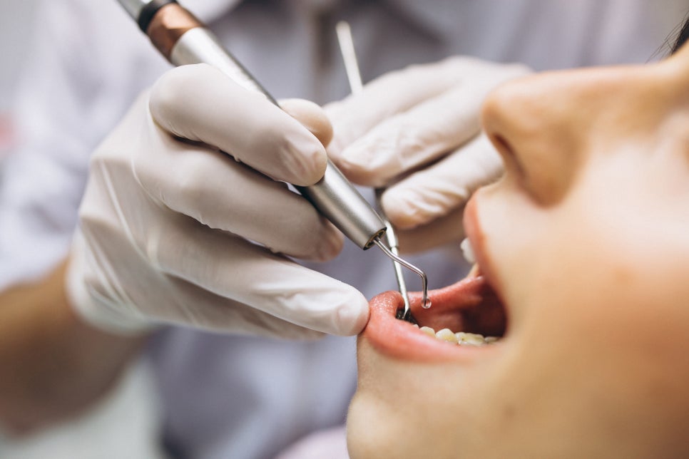 [ Magok Teeth Whitening_05 ] How Long Do the Effects of Teeth Whitening Last? image 4