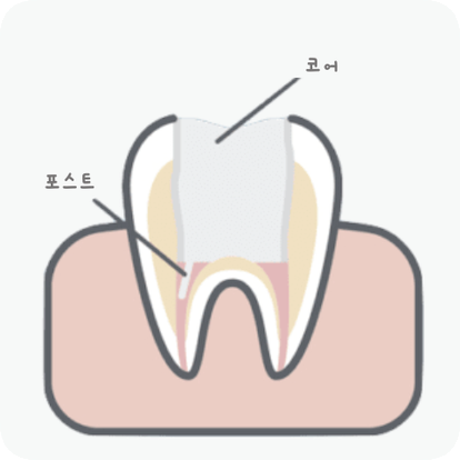 마곡동치과_ "치아 속 구조 복원 프로젝트" [2. 신경치료 단계별 진행 과정 ] 관련 이미지 5