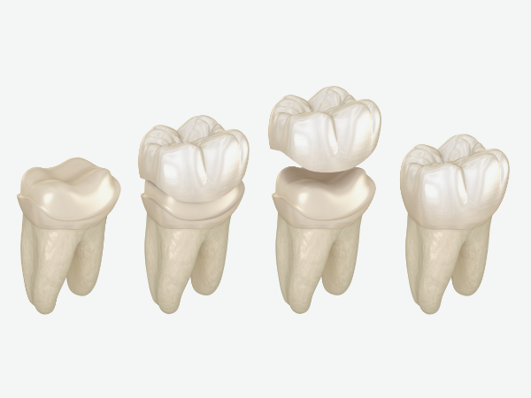 마곡 치과 _2. 씹을 때 치아 통증 치료 방법, 원인에 따라 달라집니다 관련 이미지 1